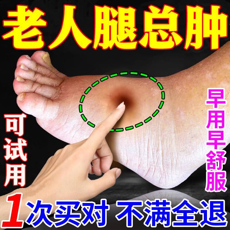 祛脚肿水肿的药小腿部浮肿胀老人脚水肿的药泡脚排肿排水神器