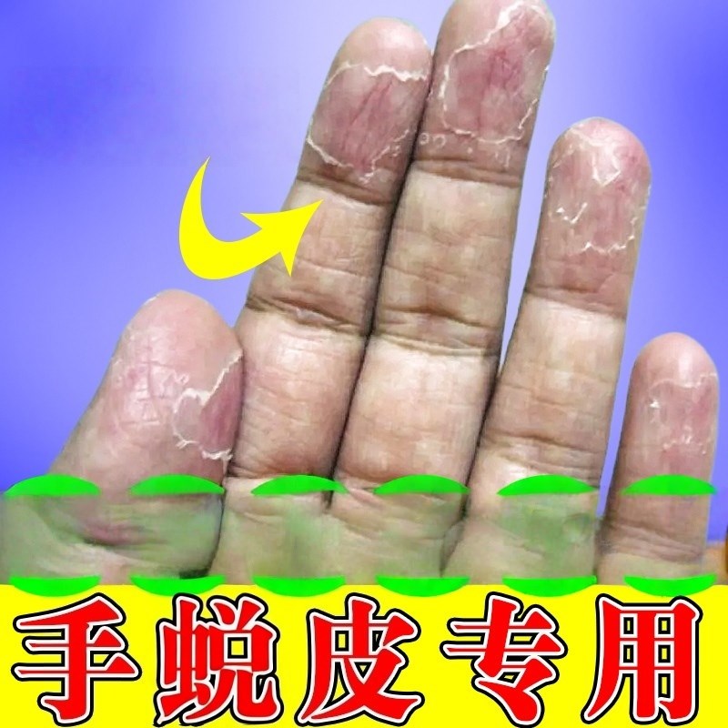 手严重脱皮专用冬季手掉皮干裂真菌感染季节性手蜕皮防脱皮膏