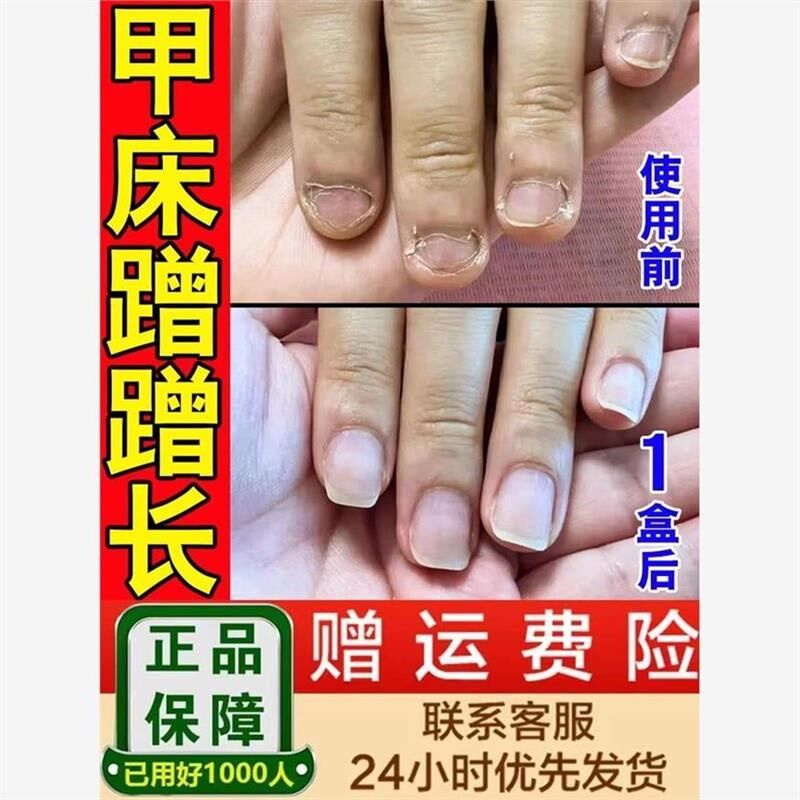 甲床修复生长液啃咬指甲受损萎缩再生甲肉分离空甲断裂护甲油增长