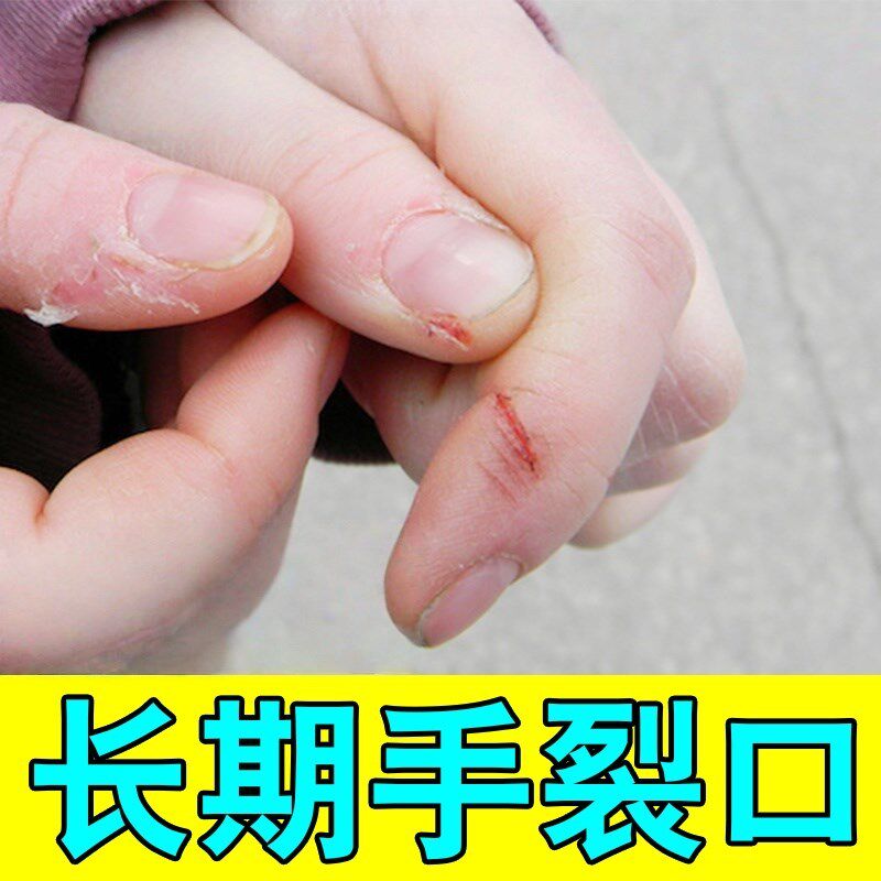 手裂口子干燥粗糙爆干皮感染真菌治手裂口脱皮角质增厚指甲缝开裂