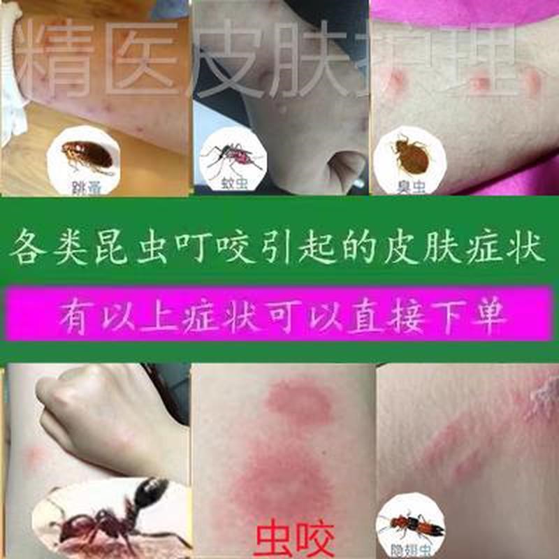 治被虫子咬性皮炎隐翅臭虫跳蚤蚊子叮咬止痒螨虫红蚂蚁咬伤的药膏