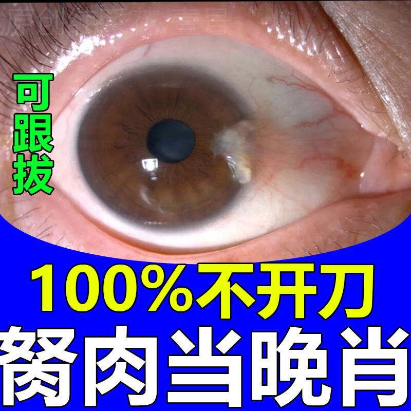 去除眼睛胬肉滴眼液眼睛长胬肉有异物感模糊看不清翼状胬肉眼药水
