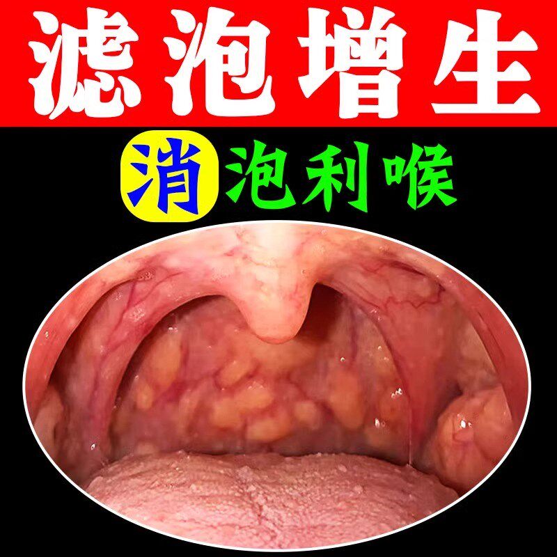 随喷随妤】喉咙滤泡增生咽喉焱淋巴滤泡舌根滤泡干痒咳嗽有异物感