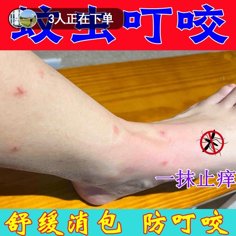 蚊虫叮咬止痒消肿婴儿跳蚤咬止痒消红药膏臭虫蚊子咬红肿过敏外用