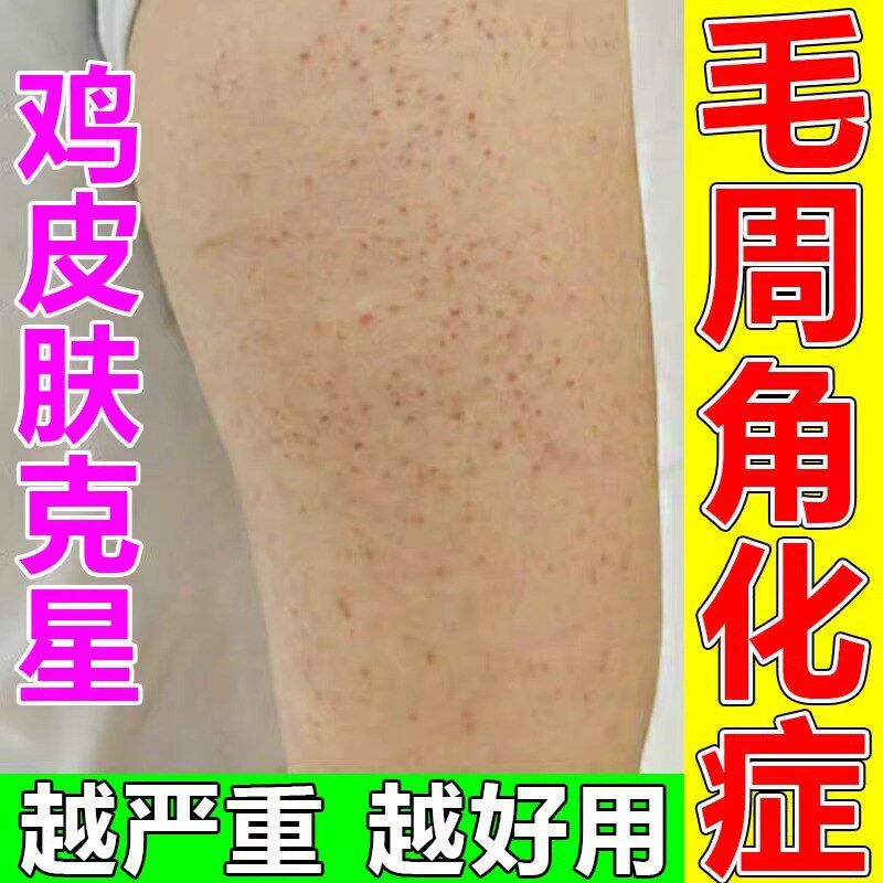 鸡皮肤去除神器干燥起皮瘩毛囊疙角化角质鱼鳞蛇霜病皮肤护理乳霜