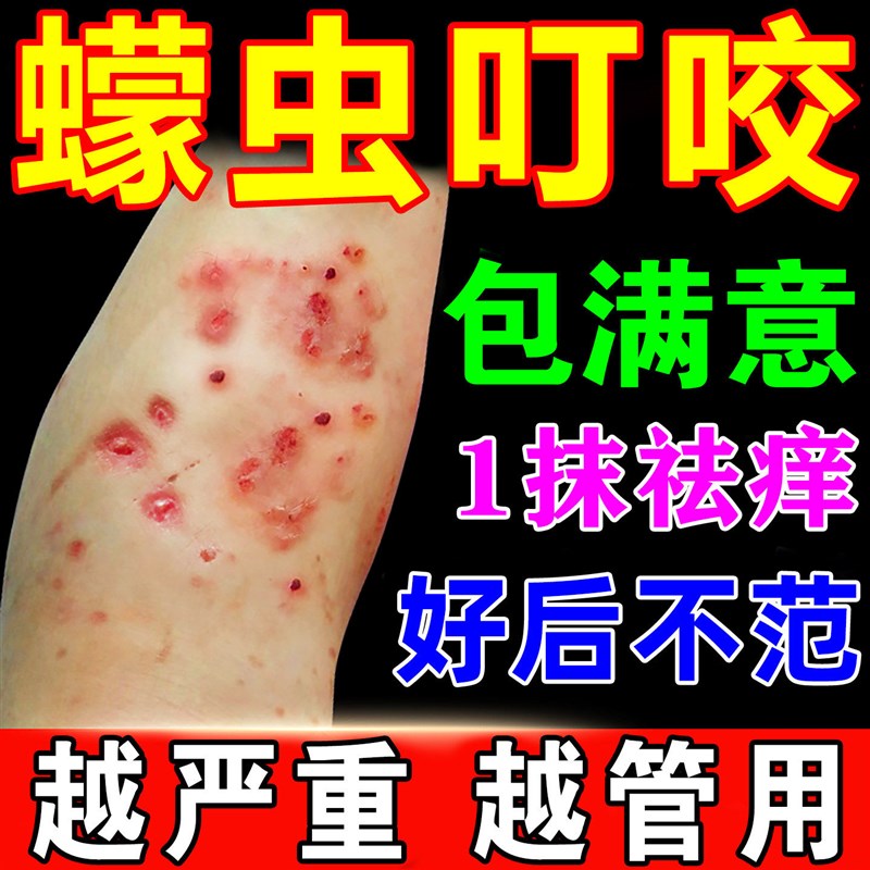 蠓虫咬伤止痒膏蚊虫叮咬快速止痒红药膏防小咬专用皮肤一抹灵