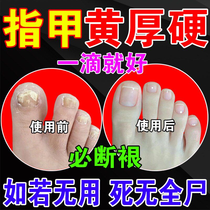 指甲发黄脚趾甲变厚增厚变黄变硬真菌性白甲空甲修复灰甲分离神器