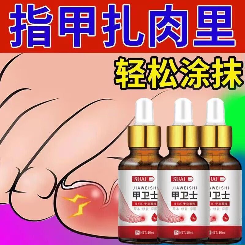 【严重甲沟炎专用】去肉芽脚趾甲往肉里长嵌甲红肿疼痛化脓抑菌液