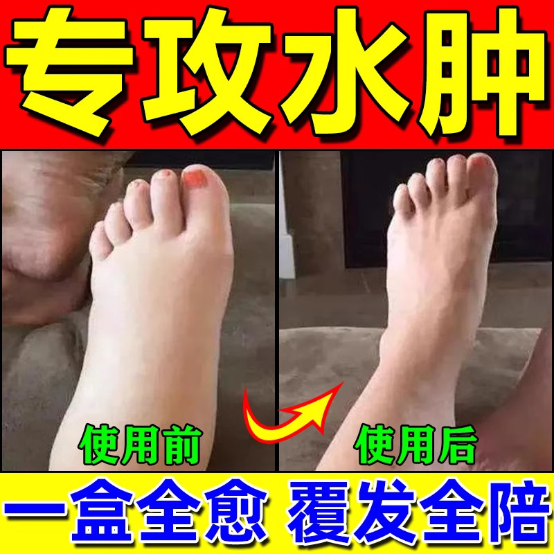 水肿贴200%利尿排水肿老人下肢脚部腿部脸部全身浮肿水肿贴