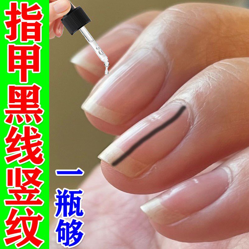 指甲有长黑线竖纹开裂灰指甲指甲增厚修复液薄软脆受损再生黑素瘤