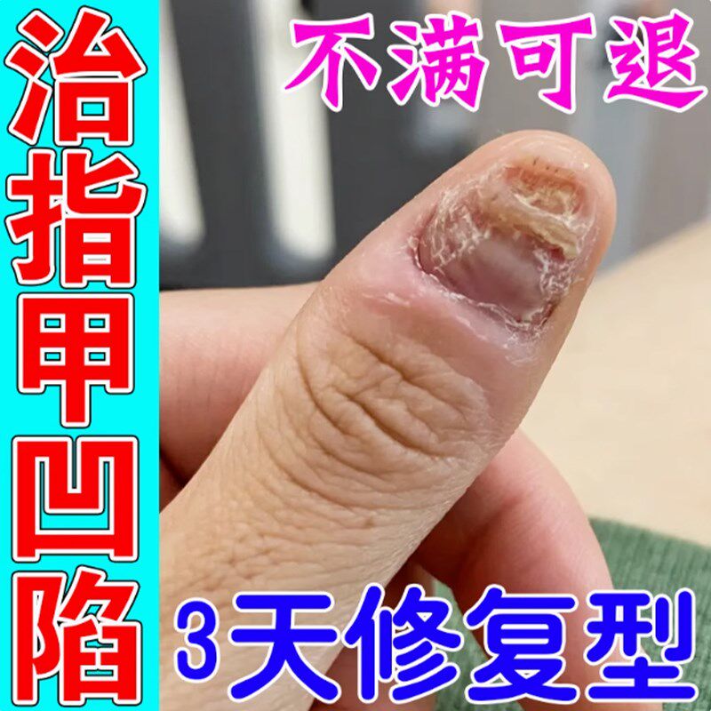 指甲盖凹凸不平修覆液受损再生甲板变软下陷灰指甲真菌感染营养油