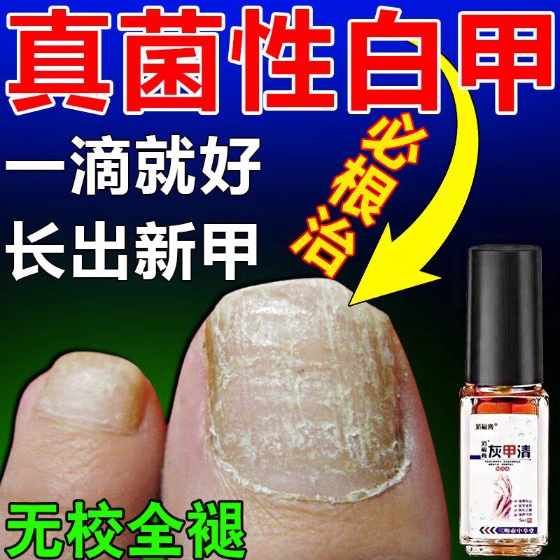 真菌性白甲脚指甲盖变厚发黄增厚趾甲变硬空灰甲床分离修复好变坏