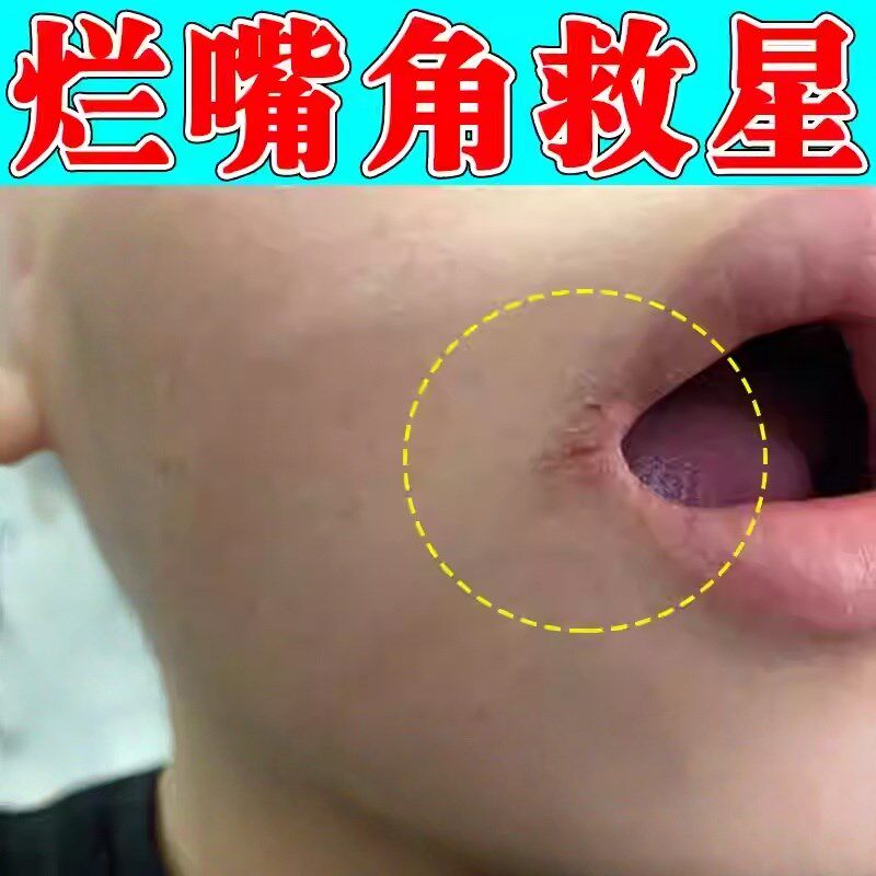 嘴角烂开裂唇诊润唇膏治口角焱嘴唇边起疱炎水泡上火修复专用唇膏
