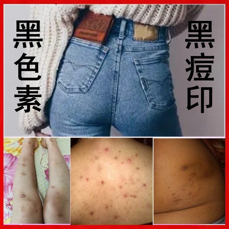 去黑痘印磨砂膏祛屁股久坐黑印黑痘印手脚后背黑痘印去身体上黑印