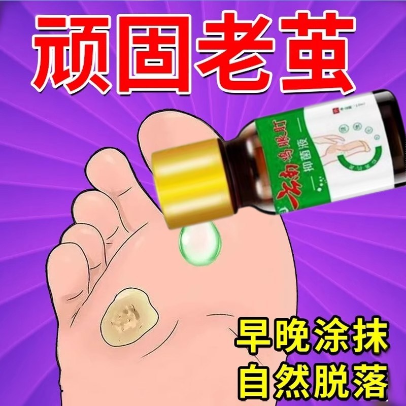老茧去除剂软化手上脚上茧脚趾脚底厚皮脚垫鸡眼自然脱落神器正品