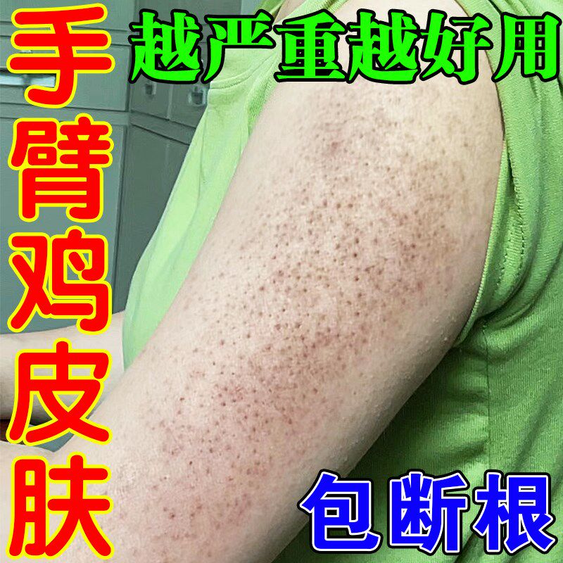 鸡皮肤疙瘩色素沉着毛周毛囊角化药膏去除胳膊脸腿上脖子红点黑点