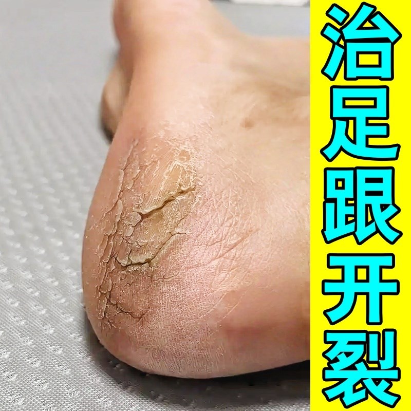 脚后跟干裂感染真菌滋润修复霜足跟开裂起硬皮去死皮脱皮专用膏