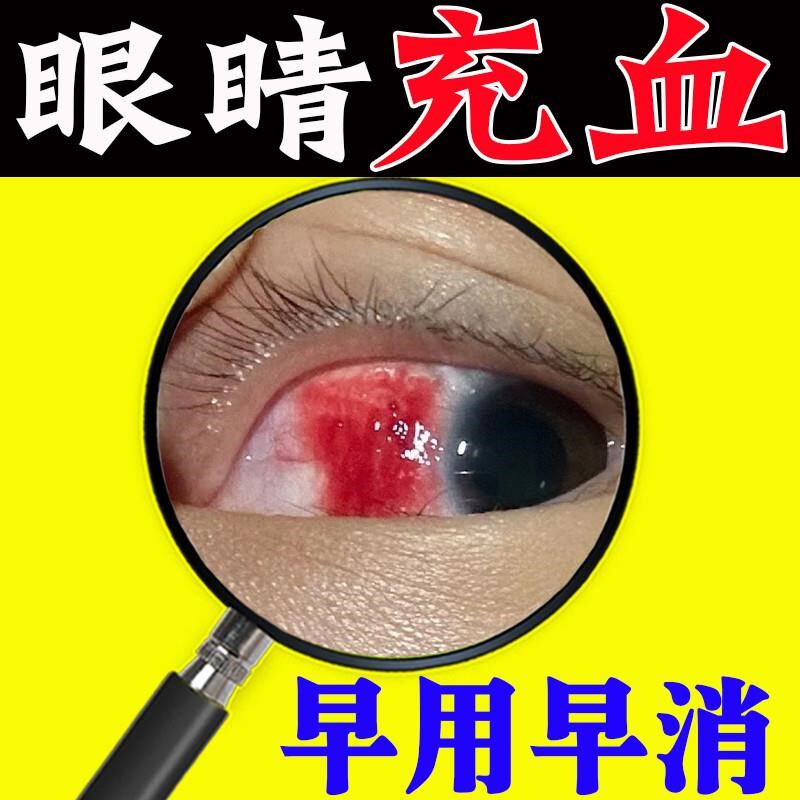 眼睛充血0刺激草本眼水专治眼睛充红血丝有异物感畏光结膜炎