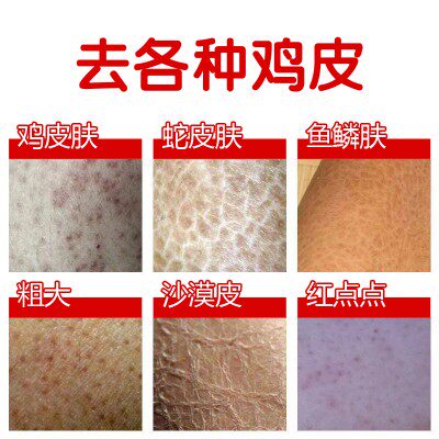去鸡皮肤去除腿部全身去毛周角化祛腿上鸡皮疙瘩 去除膏鸡皮霜