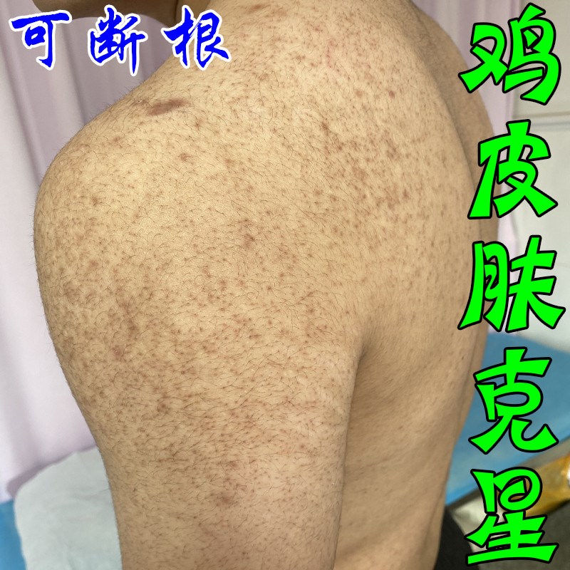 鸡皮肤去除胳膊手臂大腿毛囊毛周角化皮肤粗糙起小颗粒红点修覆霜