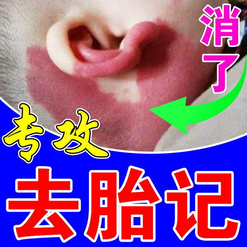 胎记去除神器红色胎记遮脸部咖啡斑鲜红斑祛黑色素淡化修护霜药膏