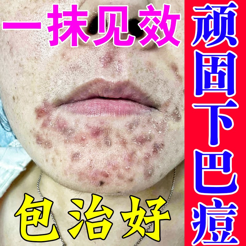 下巴反复长痘痘嘴周痤疮脓包硬块祛痘印黑头淋巴痘腮边痘收缩毛孔