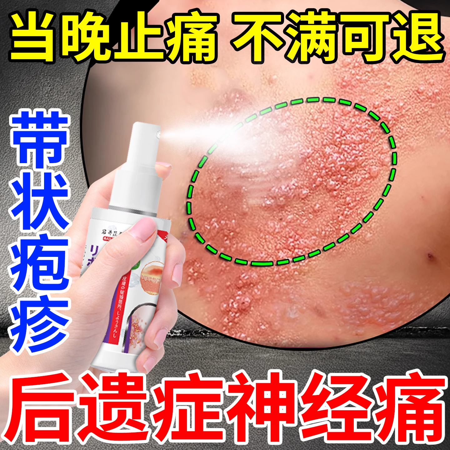 带状疱疹后遗症神经痛特汗