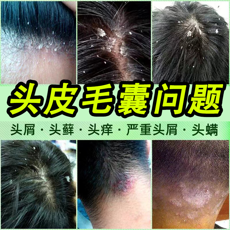 头部皮屑癣上长痘结痂可搭