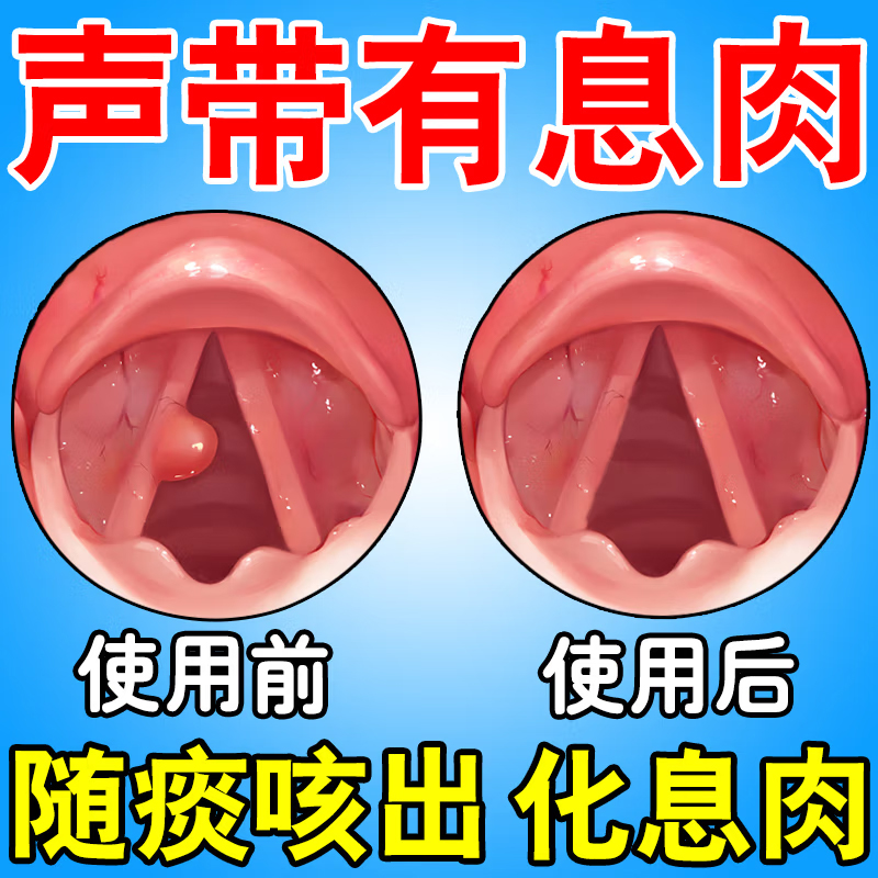 声带息肉否药嗓子哑声音嘶哑修复非治喉咙沙哑声带小结有异物感疼