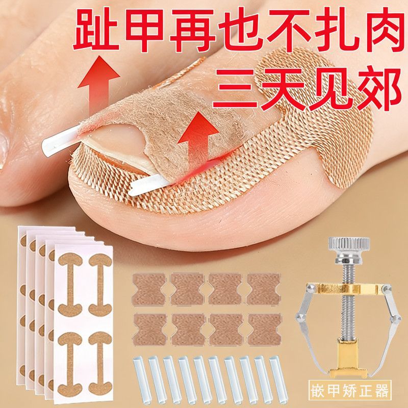 脚指甲盖矫正器甲沟贴嵌