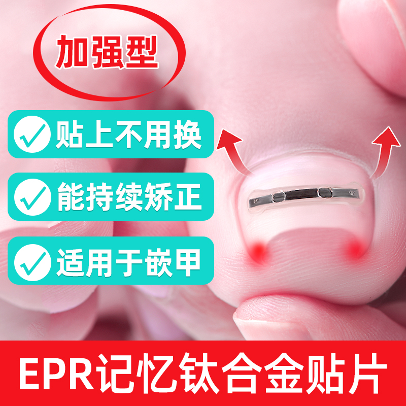 脚医生甲沟炎嵌甲矫正器