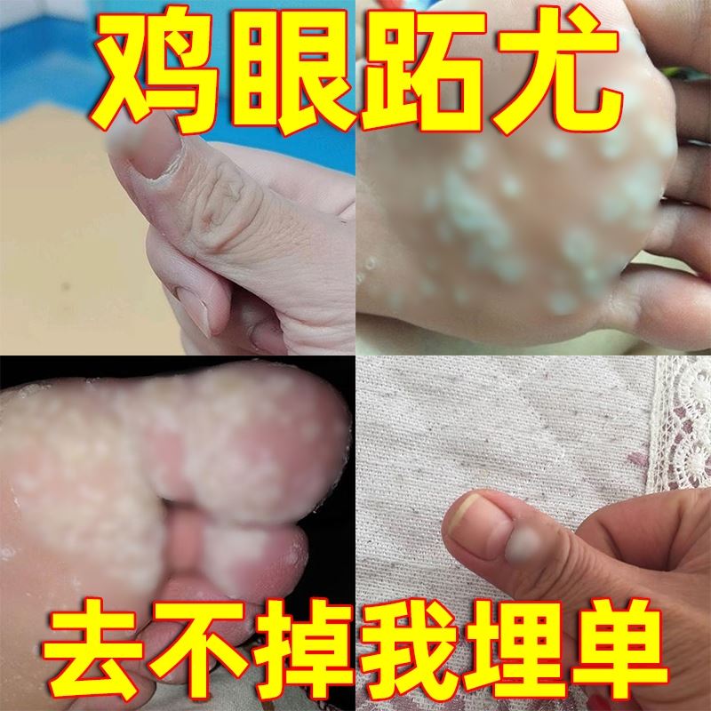 草本跖疣膏安全甲周疣专用药肉刺去除膏手部鸡眼瘊子去除神器脚底