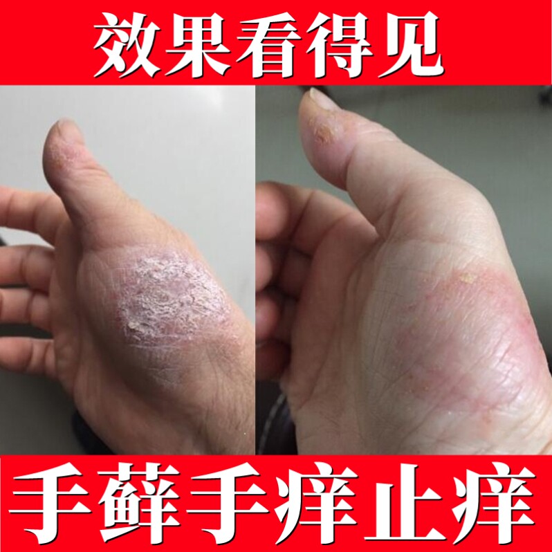 手痒干裂真菌感染手上起小水泡专用药膏汗泡疱疹药膏汗斑癣专用药