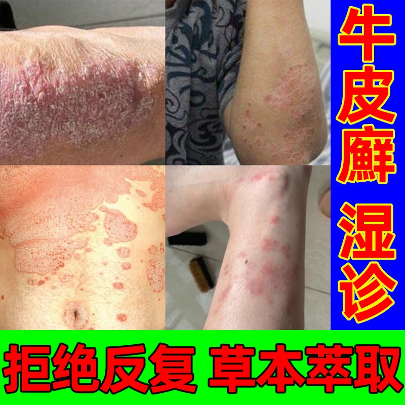 疥苍膏止痒膏硫磺软膏治干疮的药藓药膏玫瑰糠疹药膏真菌感染痘痘