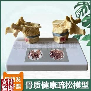 人体骨骼模型脊椎k骨质密度疏松老年人骨骼椎间盘压迫神经演示病