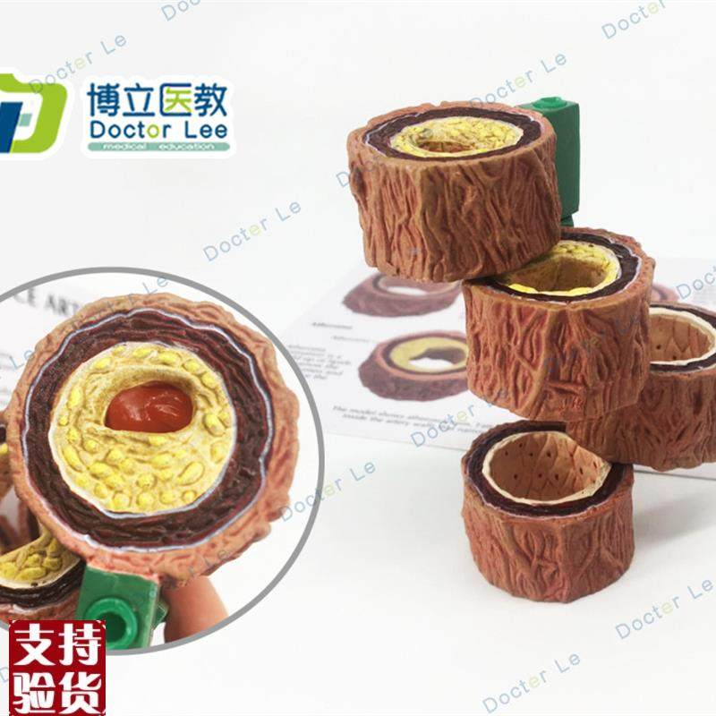 动脉粥样化模型血栓病变模型心血管模型医学W模型教学模型
