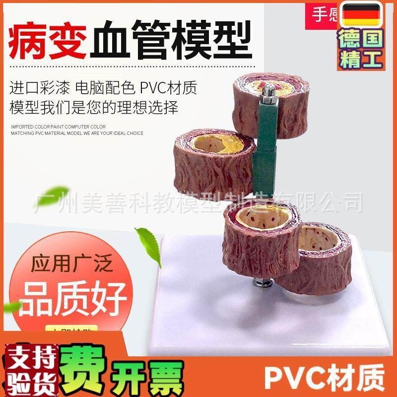 人体血管模型血管/堵塞老年人血C管栓/塞/模型血管/病理模型