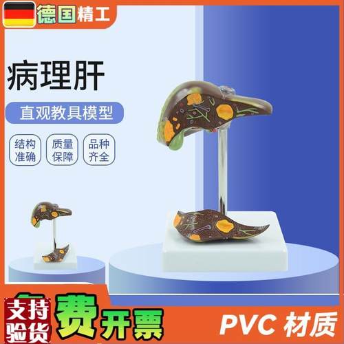 德国】肝脏病理病理肝模型结石胆L模型肝演示病理胆囊