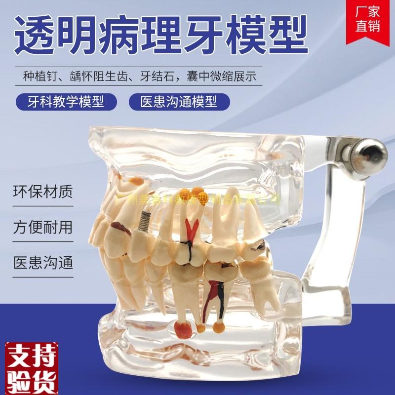 牙齿模型自然大透明r牙体病理模型口腔科病理模型医患模型