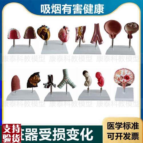 心脏模型病理正常对比吸烟有害心血管肺气管口腔牙齿Y戒烟警示教