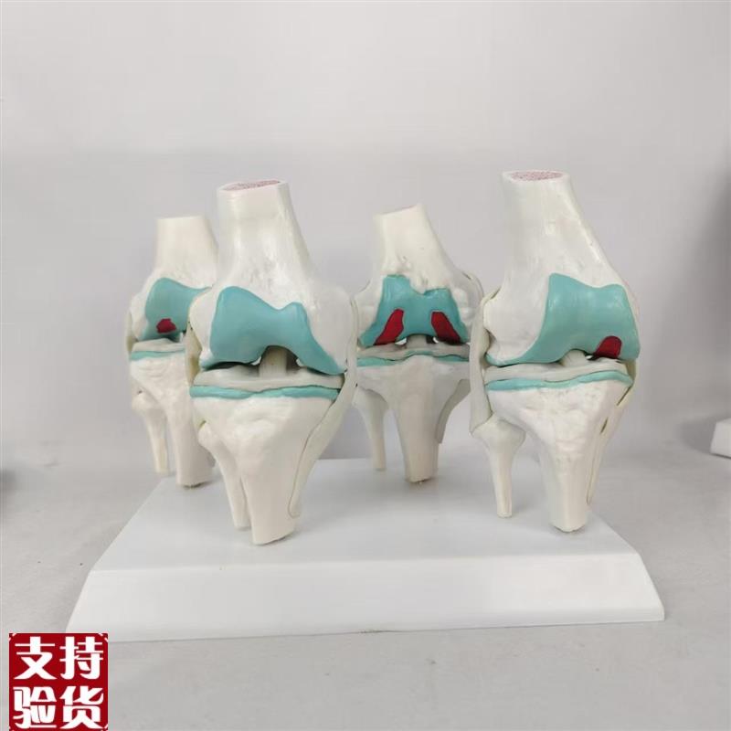 人体一比一膝关节病变对比模型半月F板软骨韧带病变对比膝盖病理