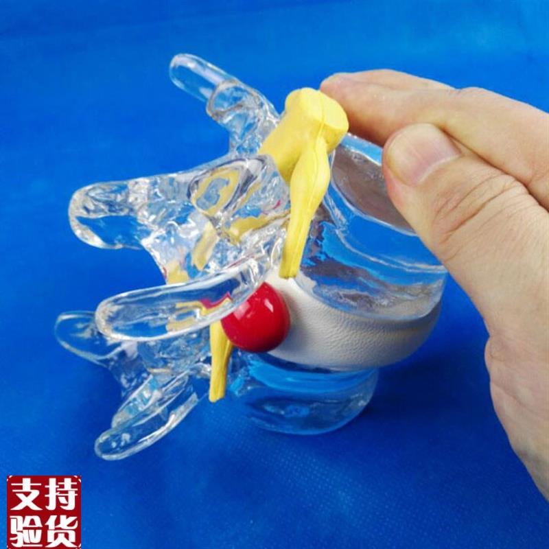 腰椎间盘受压突出演示模r型压迫神经脊椎骨劳损2节腰椎可拆卸病理