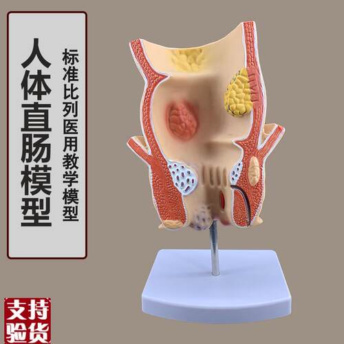 痔疮直肠病理模型溃杨性结肠病肠直肠解剖M病理模型病态疾病教具