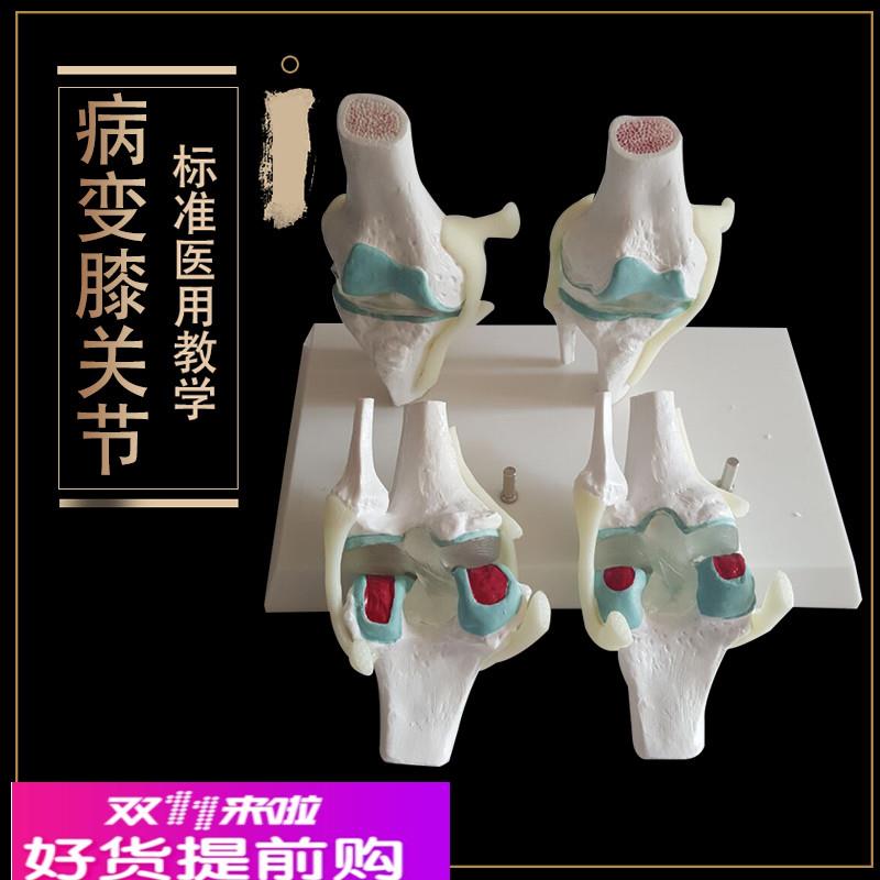 病变膝关节模型病态膝关节模型 变态四阶段 骨骼模型关节教学模型