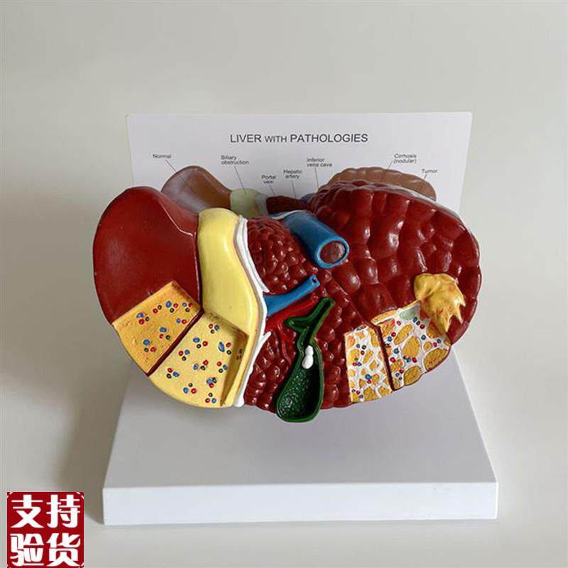 病理肝脏模型胆囊肝门静脉脂肪酒精炎肝脏医O药促销医患胆总管肝