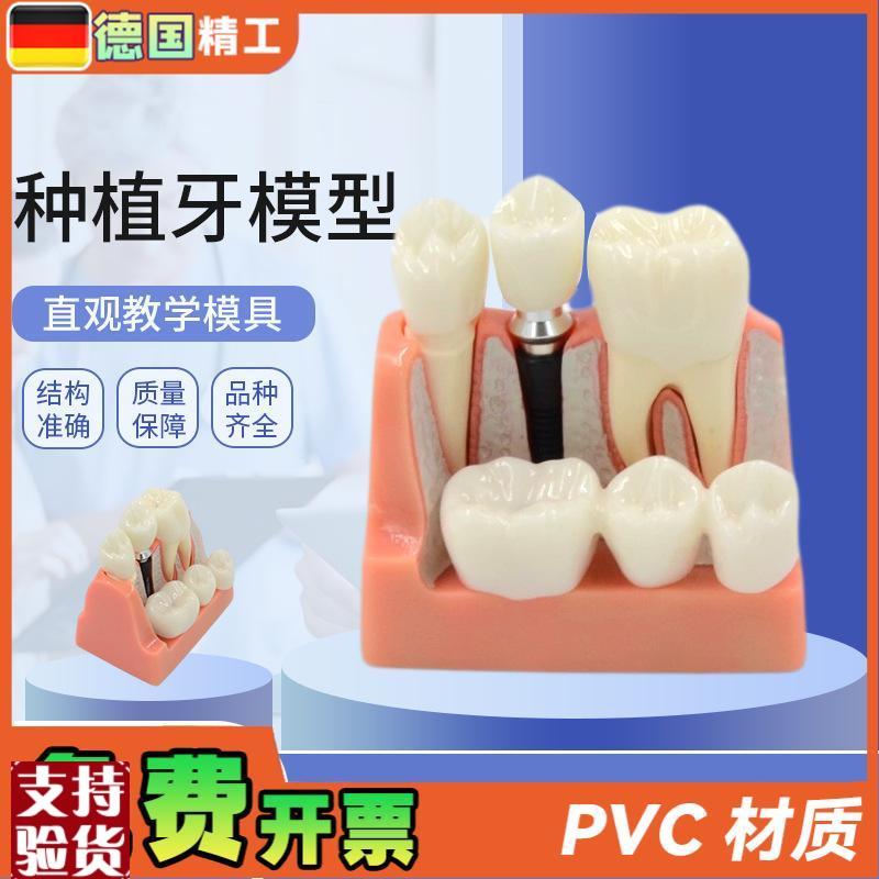 德国】种植牙模型人体口腔牙齿模型透明牙模V型牙种植模型
