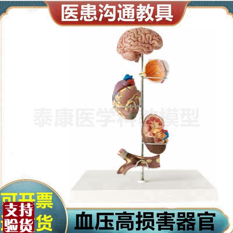 心脑血管模型血液压力升高病x理脏器受损糖尿眼底肾脏冠状动脉阻