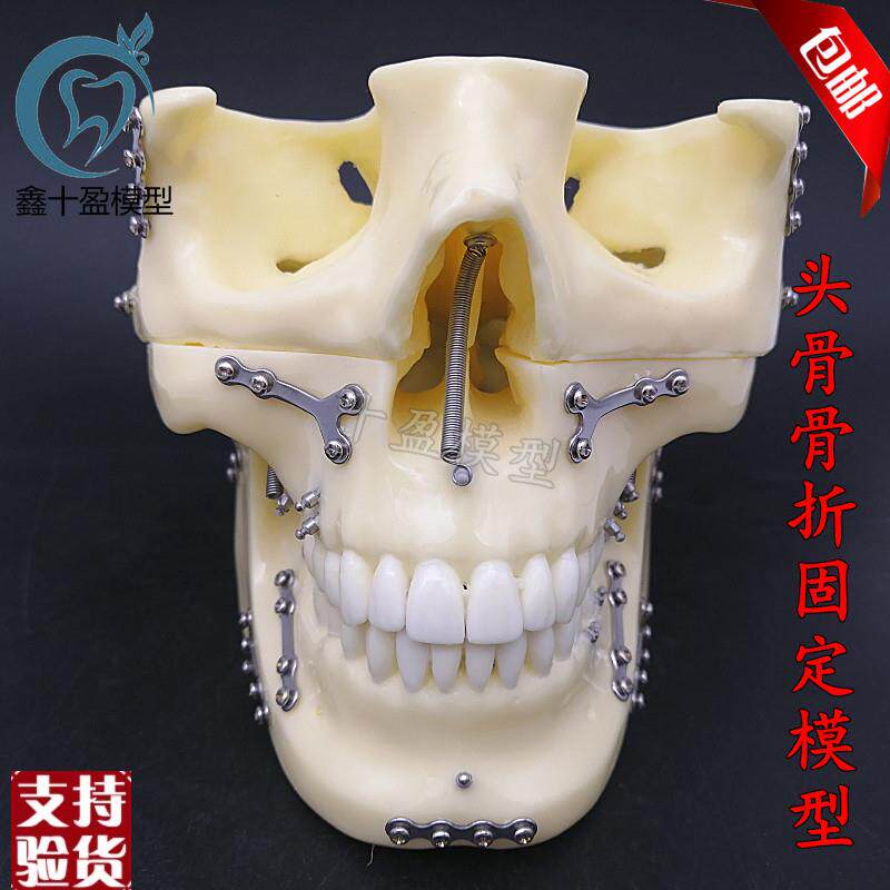 牙科种植支抗钉模型头颅t骨折固定模型头颅骨口腔模型医学教学