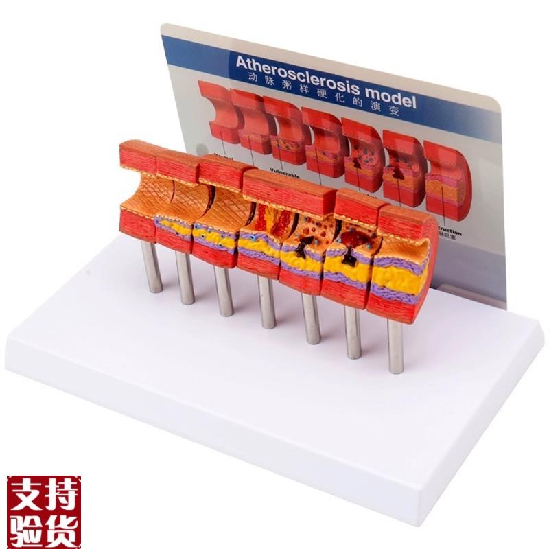 心脑血管堵塞动支脉n粥样硬化血栓血液浓度脂肪病理教学用模型道