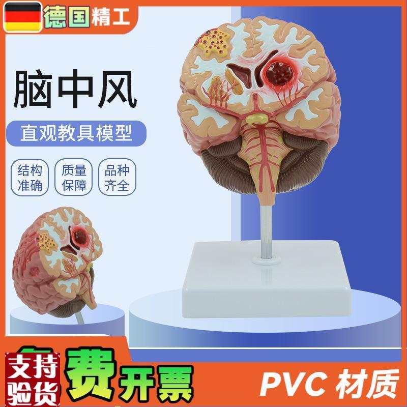 德国】人体脑f解剖模型脑出血动脉大脑动静脉畸形脑病理大脑教具